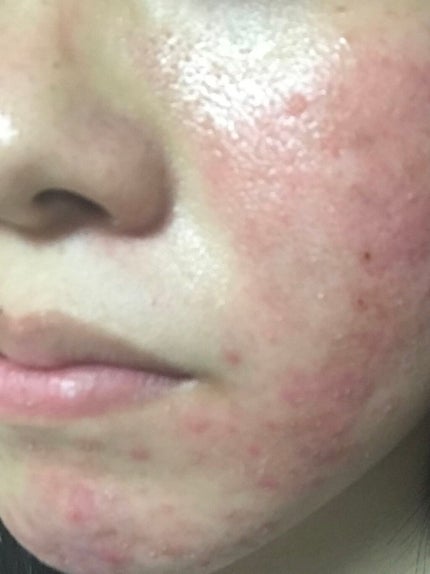 エピデュオゲル/マルホ株式会社/その他を使ったクチコミ(2枚目)