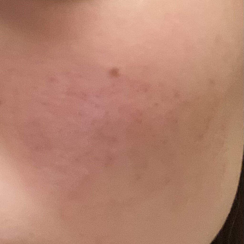 ディフェリンゲル0.1% /マルホ株式会社/その他を使ったクチコミ（2枚目）