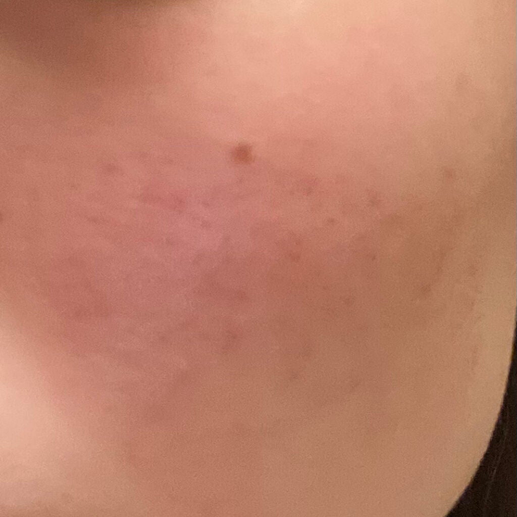 fresh_rouge_fe3j4iaj on LIPS 「ディフェリンゲルを使い始めて1週間が経ちました!私はやっと今日..」(2枚目)