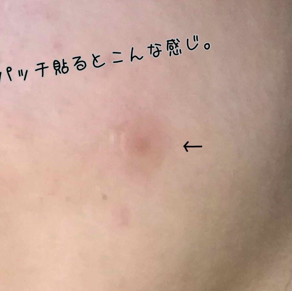 ゼロスポットパッチ/Today’s Cosme/にきびパッチを使ったクチコミ(2枚目)