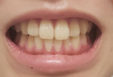 アパガードプレミオ/アパガード/歯磨き粉を使ったクチコミ(3枚目)