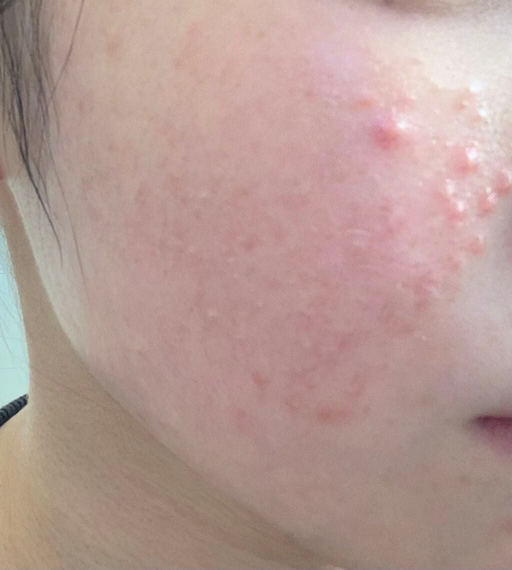 p on LIPS 「(※写真2枚目▷右頬3枚目▷左頬)お見苦しい、、ごめんなさい。..」(2枚目)