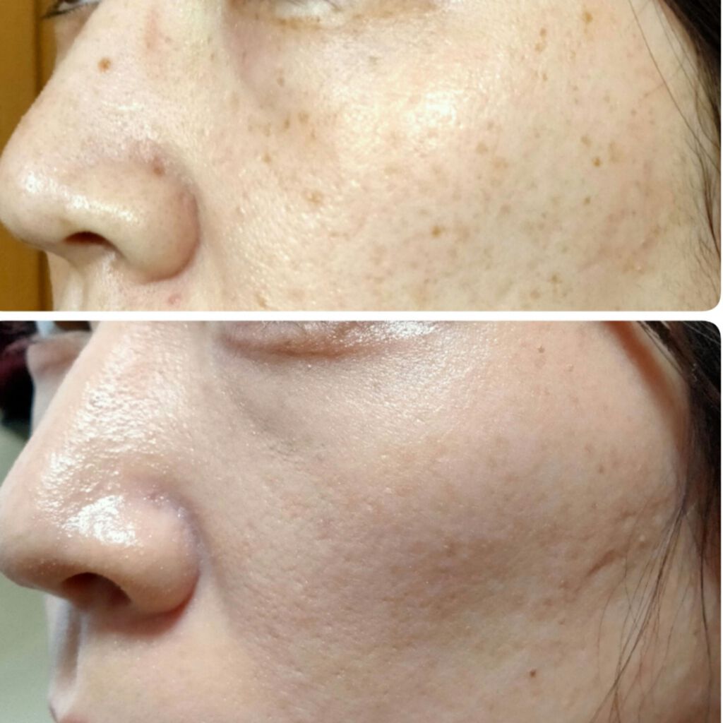 【旧】ディオールスキン フォーエヴァー フルイド グロウ/Dior/リキッドファンデーションを使ったクチコミ(1枚目)