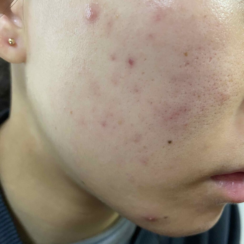 ゼビアックス(医薬品)/マルホ株式会社/その他を使ったクチコミ（2枚目）