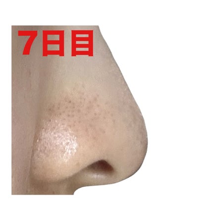 薬用 しみ 集中対策 美容液/メラノCC/美容液を使ったクチコミ(10枚目)