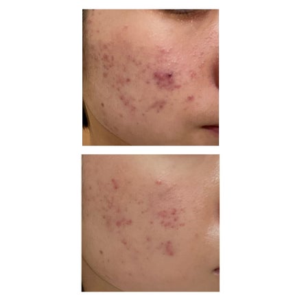 クリンダマイシンゲル(医薬品)/クラシエ薬品/その他を使ったクチコミ(2枚目)