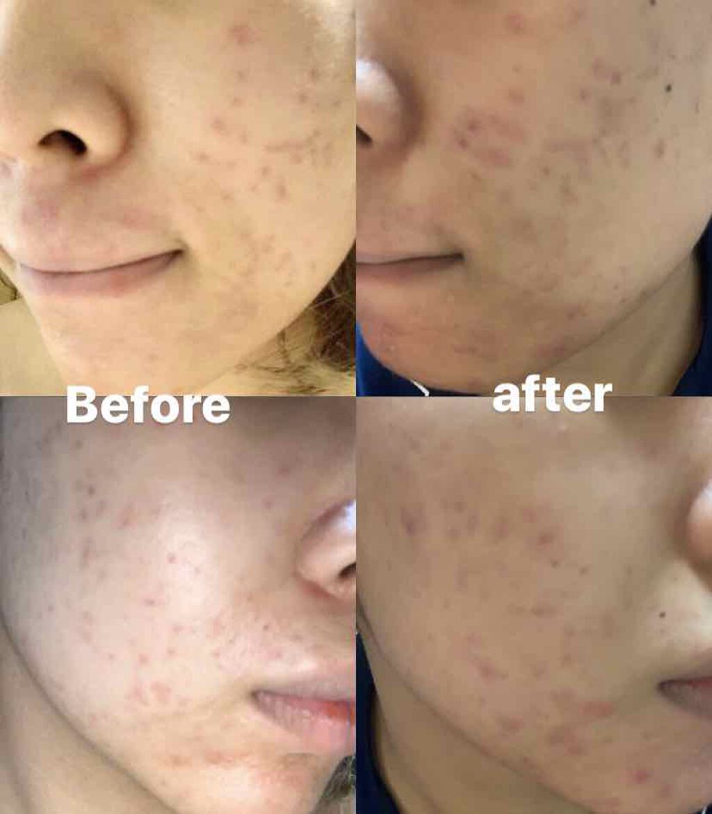 ゼロ毛穴パッド/MEDICUBE/ブースター・導入液を使ったクチコミ(2枚目)