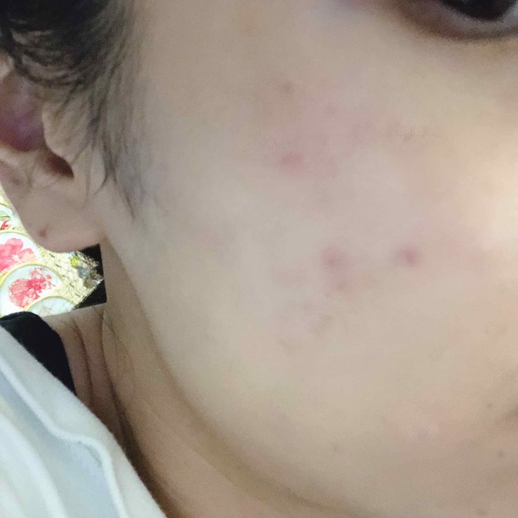 ベピオゲル/マルホ株式会社/その他を使ったクチコミ（1枚目）