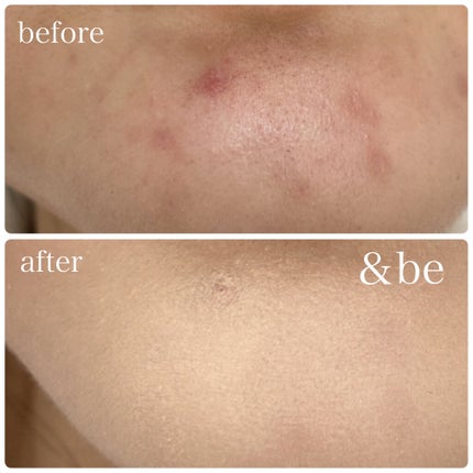 【旧】ディオールスキン フォーエヴァー スキン コレクト コンシーラー/Dior/リキッドコンシーラーを使ったクチコミ(4枚目)