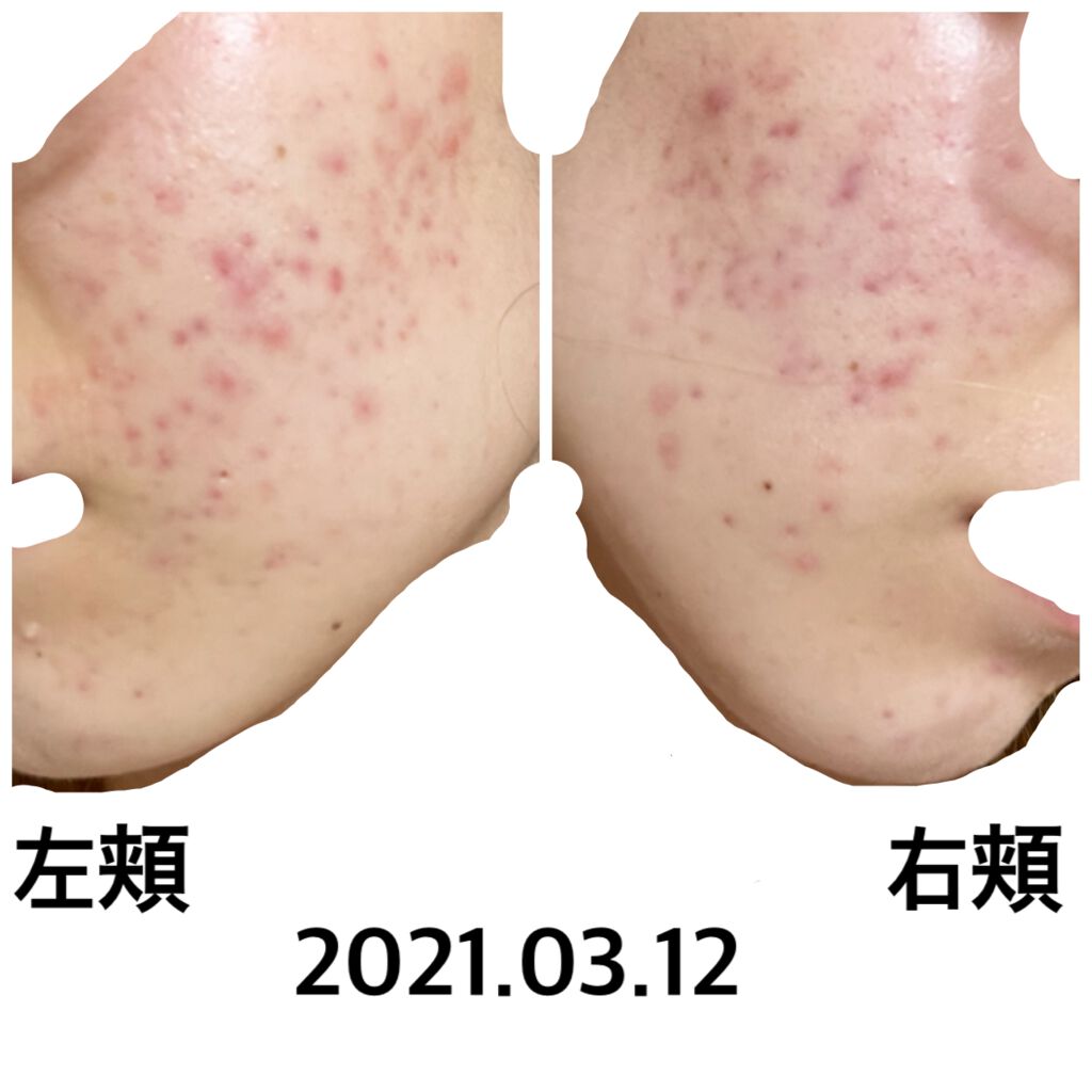 A/O+ P.M.クリア ユース ラディアント クレンジング オイル/shu uemura/オイルクレンジングを使ったクチコミ（1枚目）