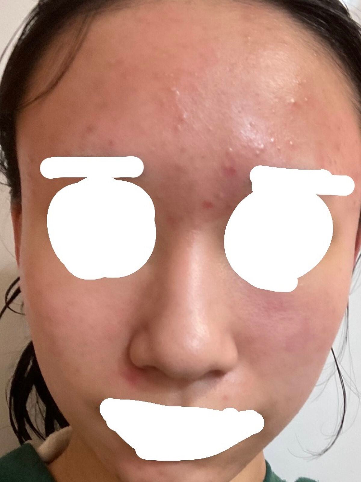 A アクネフォーム/NOV/洗顔フォームを使ったクチコミ(2枚目)