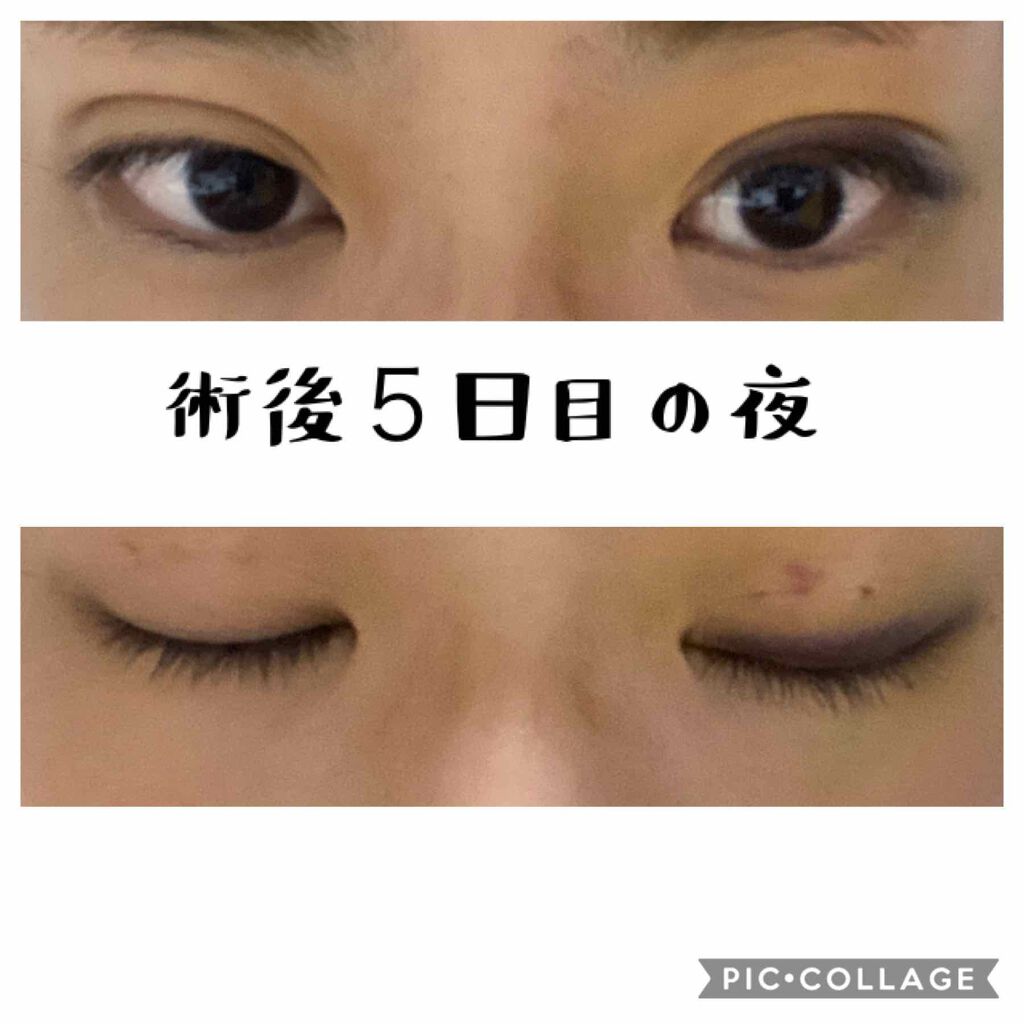 すもも on LIPS 「術後5日目の夜です!内出血が消えないことだけが気がかりです😭#..」(1枚目)