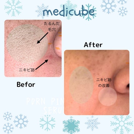 PDRNピンクアンプル PDRN 10,000ppm配合/MEDICUBE/美容液を使ったクチコミ(4枚目)