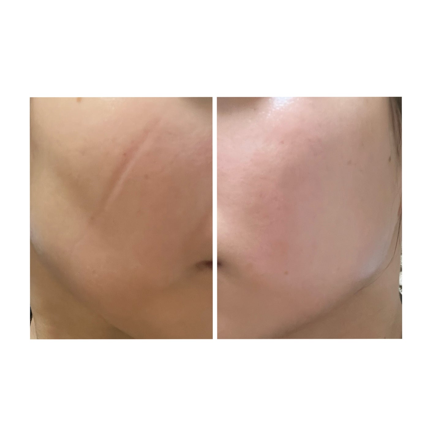 ぽむ on LIPS 「2023.9.13皮膚科に受診 エピデュオとヘパリン処方1枚目..」(2枚目)