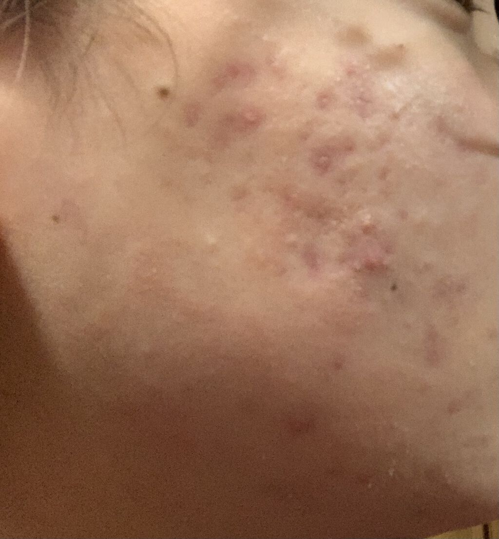 極潤プレミアムヒアルロン液(ハダラボスーパーモイスト化粧水c)/肌ラボ/化粧水を使ったクチコミ（1枚目）