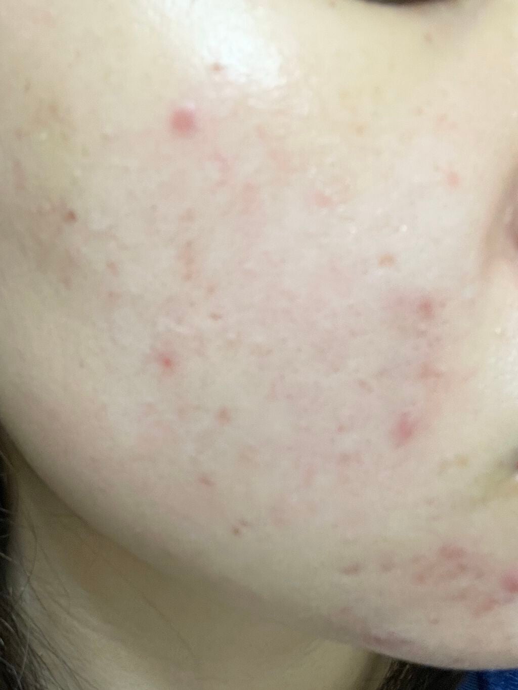 まままこ on LIPS 「ニキビゼロ肌を目指して〜9日目〜⚠️2枚目から肌画像ありスキン..」(2枚目)