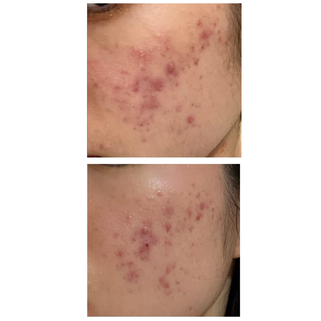 クリンダマイシンゲル(医薬品)/クラシエ薬品/その他を使ったクチコミ（3枚目）