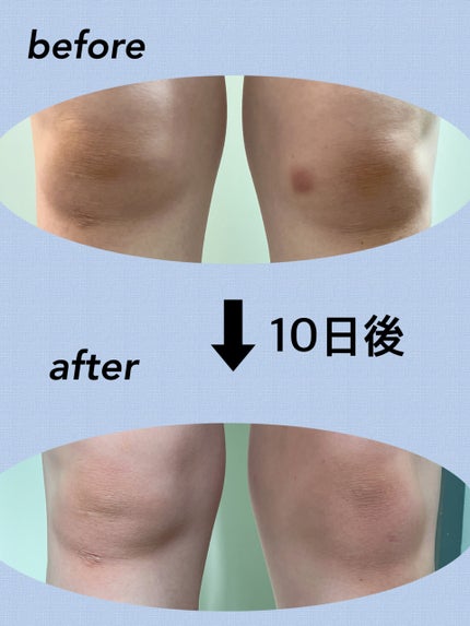 クロザラエイド(医薬品)/コーワ/その他を使ったクチコミ(2枚目)