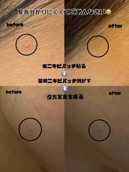 プロCICA クリアスポットパッチ/VT/その他スキンケアを使ったクチコミ(2枚目)