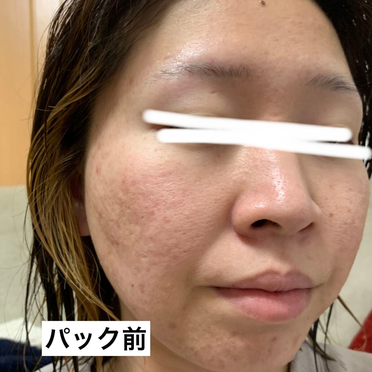 毛穴小町 テカリ源治 マスク/クリアターン/シートマスク・パックを使ったクチコミ(5枚目)