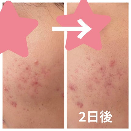 薬用 しみ 集中対策 美容液/メラノCC/美容液を使ったクチコミ(3枚目)