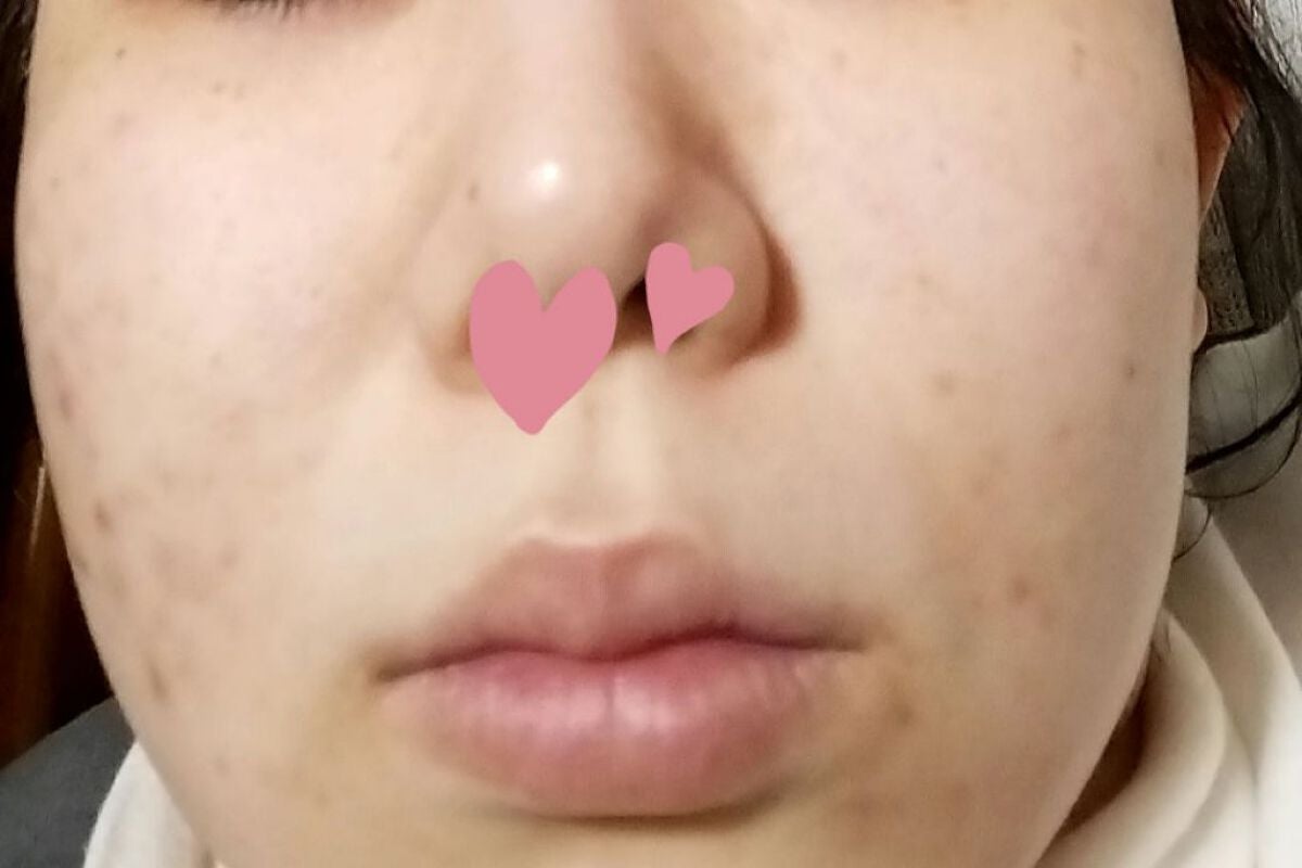 アレルバリア ミスト/d プログラム/ミスト状化粧水を使ったクチコミ(3枚目)