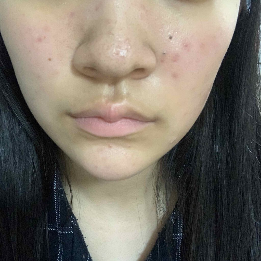 coral_sounds_078 on LIPS 「助けてください、本当に本当に肌荒れがひどく特に鼻周りのニキビが..」(2枚目)