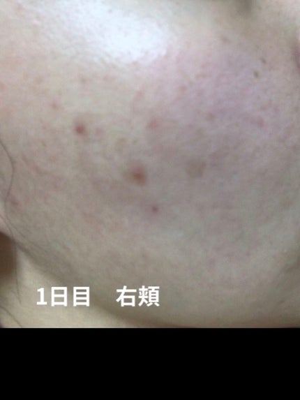 ZO Skin Healthのスキンケア・基礎化粧品 デイリーPD&ミラミン ZO Skin Healthのスキンケア・基礎化粧品 デイリーPD&ミラミン