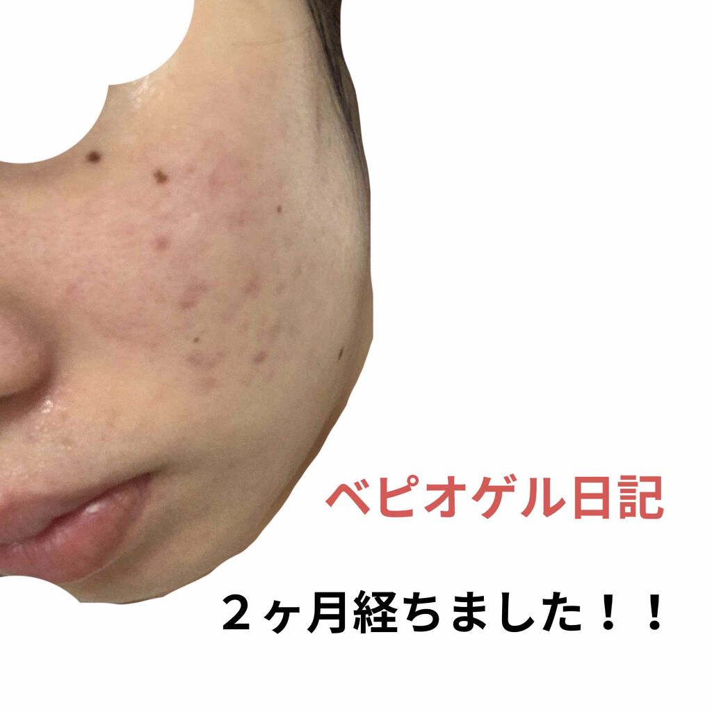 ベピオゲル/マルホ株式会社/その他を使ったクチコミ（1枚目）