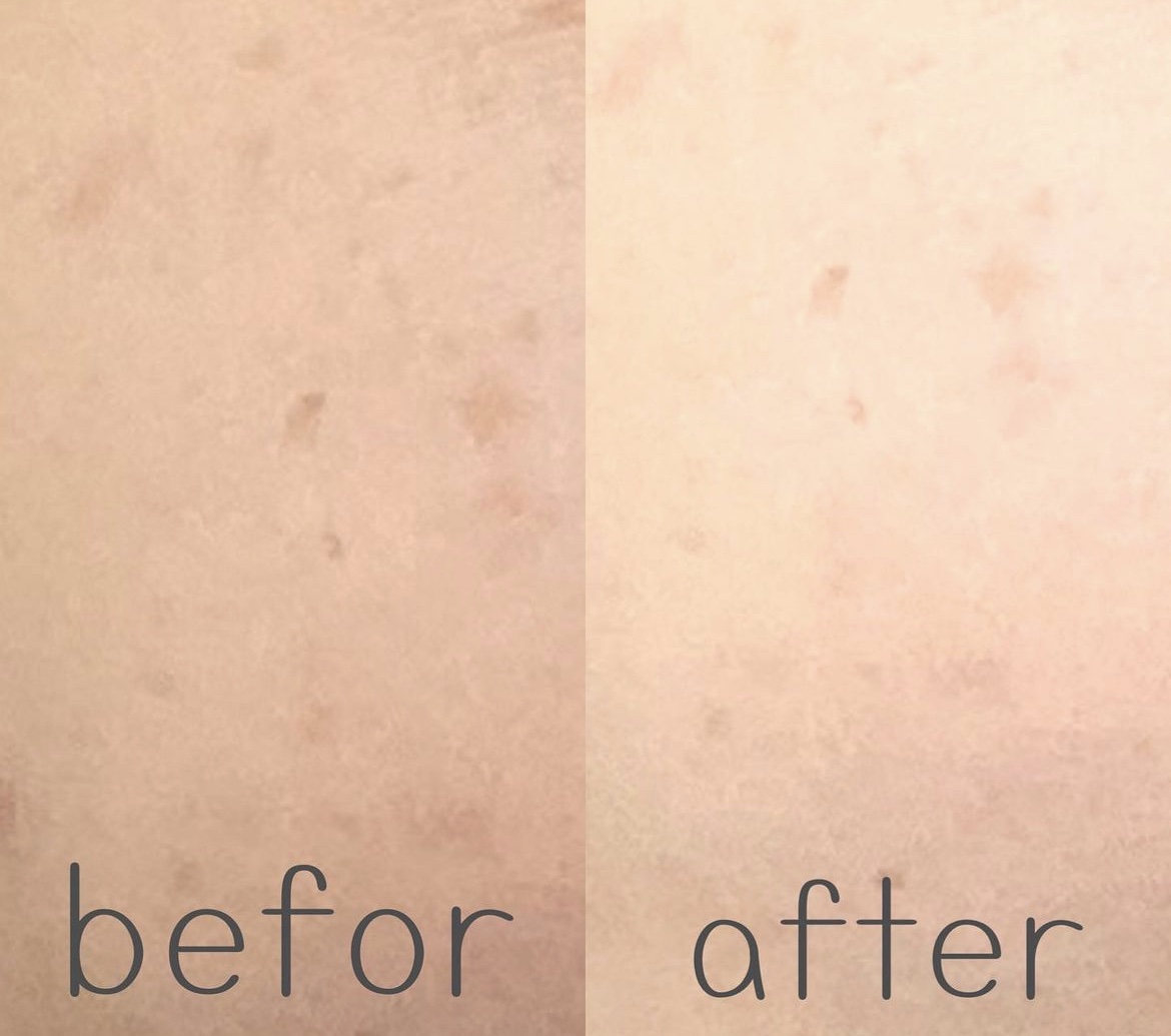 リードルショット300/VT/美容液を使ったクチコミ（3枚目）