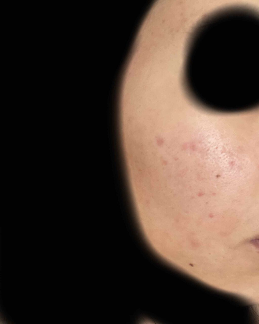 pink_sounds_rrza on LIPS 「べピオゲル15日目新しいニキビができました!マスクしててその当..」(2枚目)