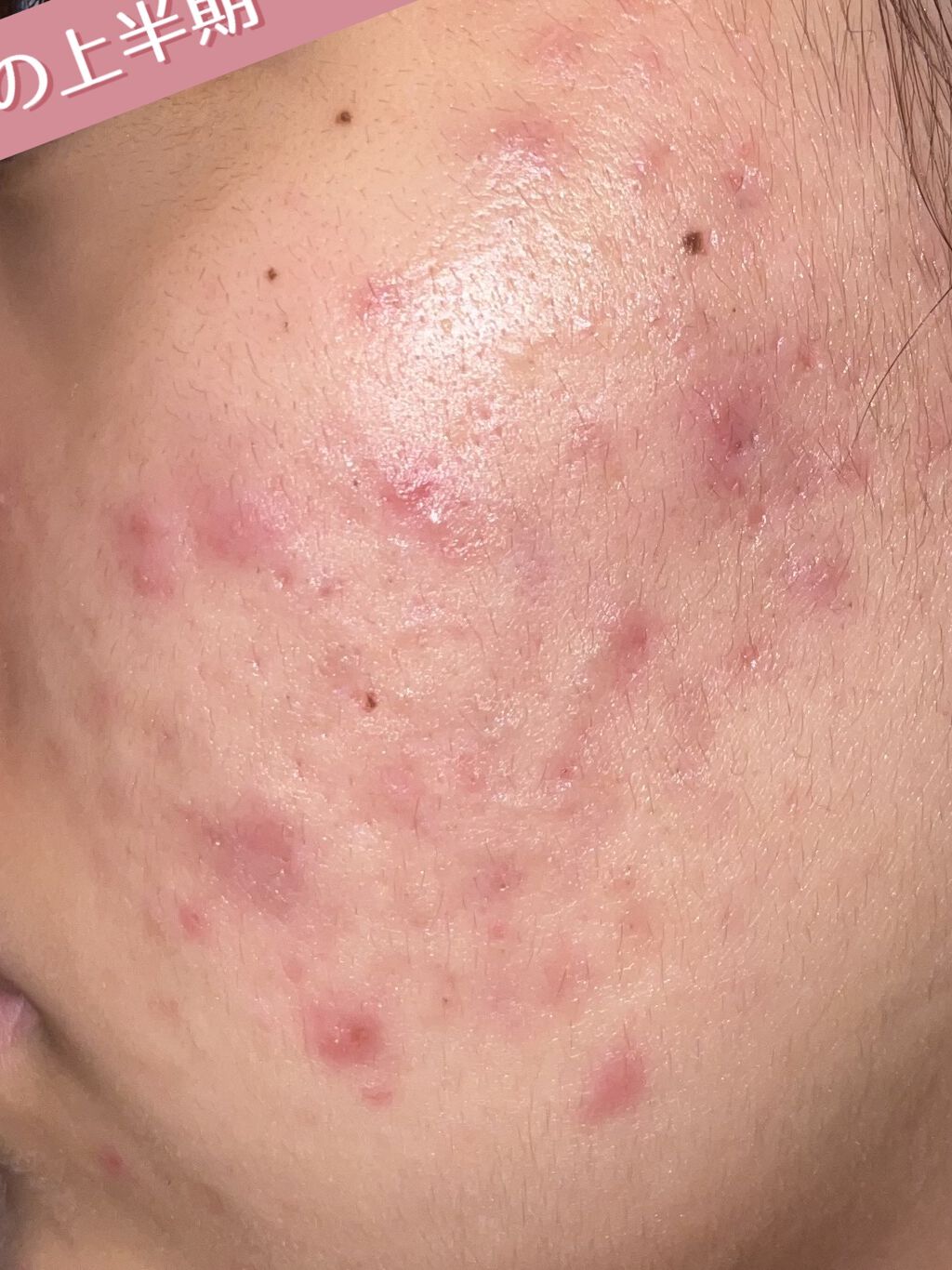 ビューティーケアマスク(ニキビ)/肌美精/シートマスク・パックを使ったクチコミ（2枚目）