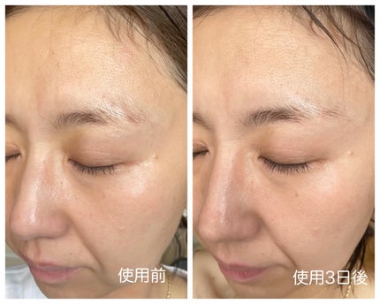 リードルショット300/VT/美容液を使ったクチコミ(4枚目)