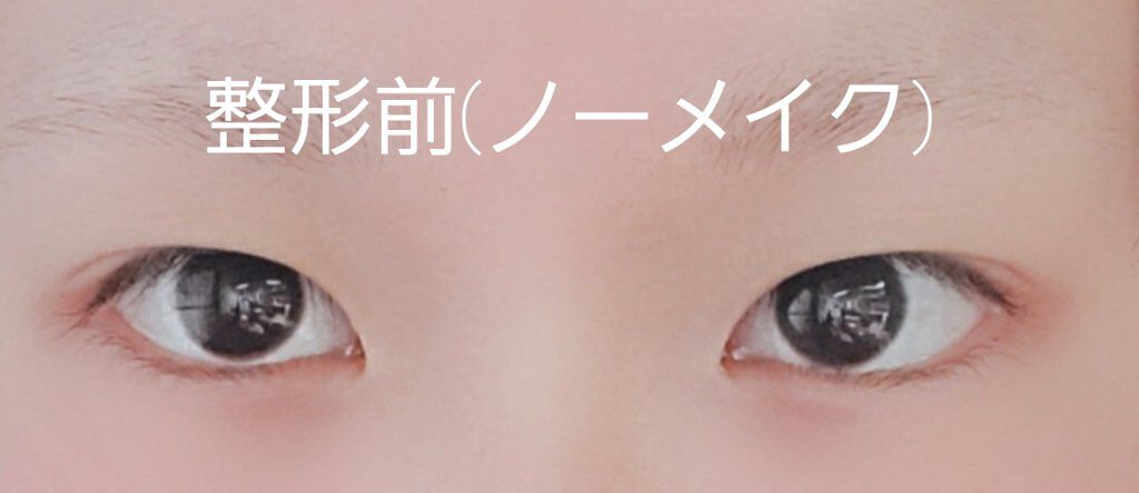 二重整形/その他を使ったクチコミ（2枚目）