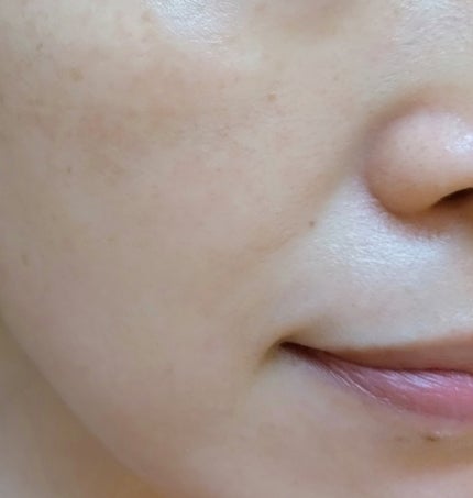 極薄透明パッチ nikipa!/金冠堂/にきびパッチを使ったクチコミ(4枚目)