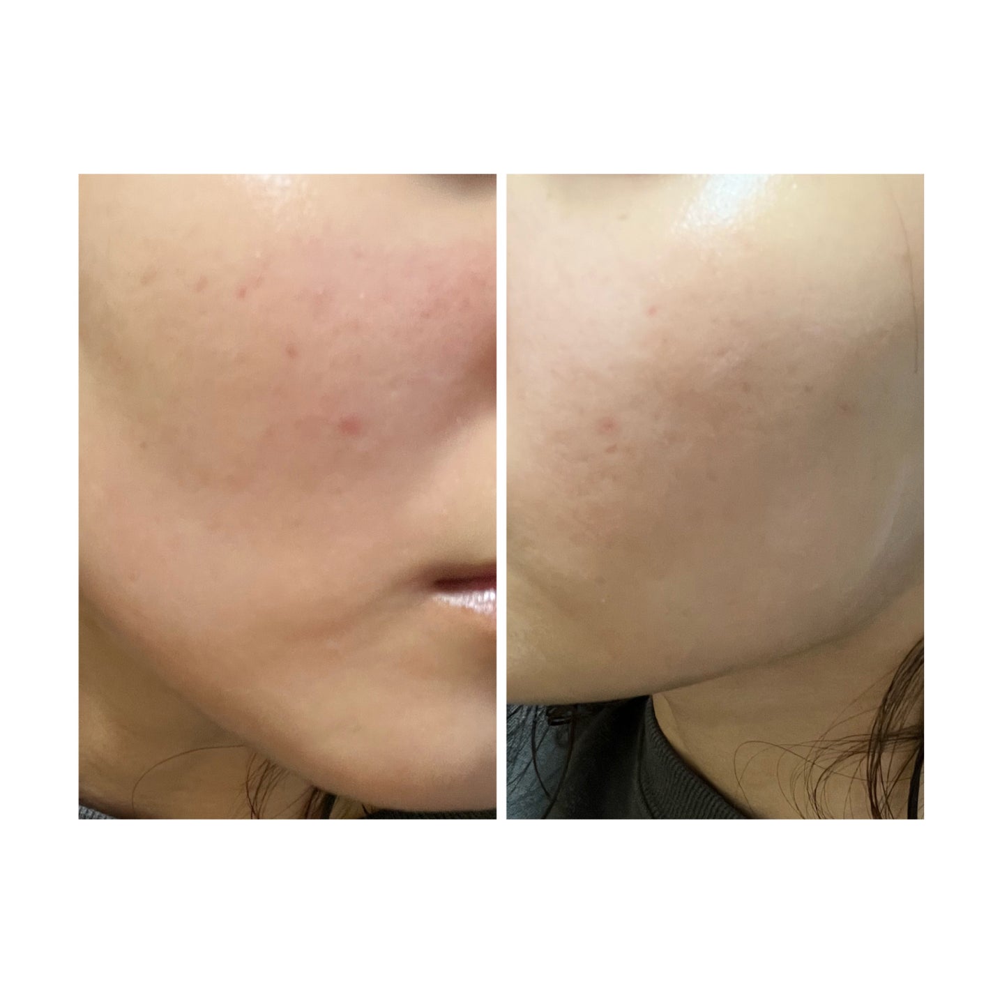 ぽむ on LIPS 「2023.9.13皮膚科に受診 エピデュオとヘパリン処方1枚目..」(4枚目)