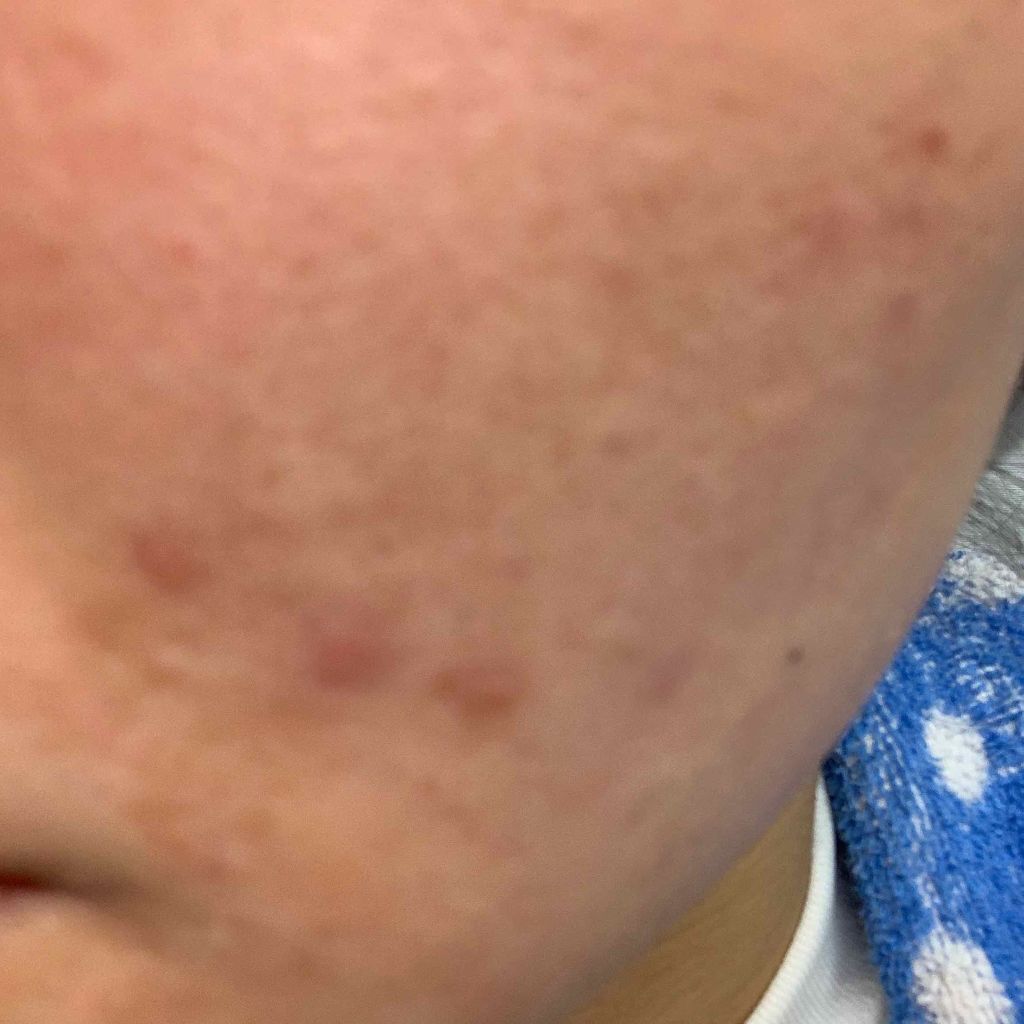 エピデュオゲル/マルホ株式会社/その他を使ったクチコミ（1枚目）