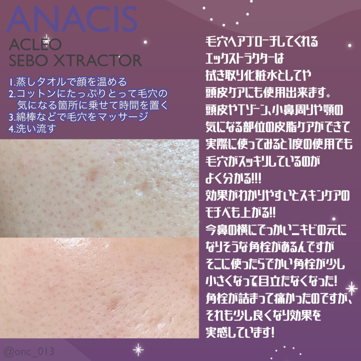 アクレオンセボエクストラクター/ANACIS/その他スキンケアを使ったクチコミ（2枚目）