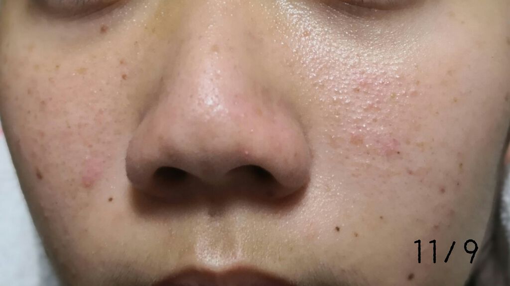 ハトムギエキス化粧水/プラチナレーベル/化粧水を使ったクチコミ（2枚目）