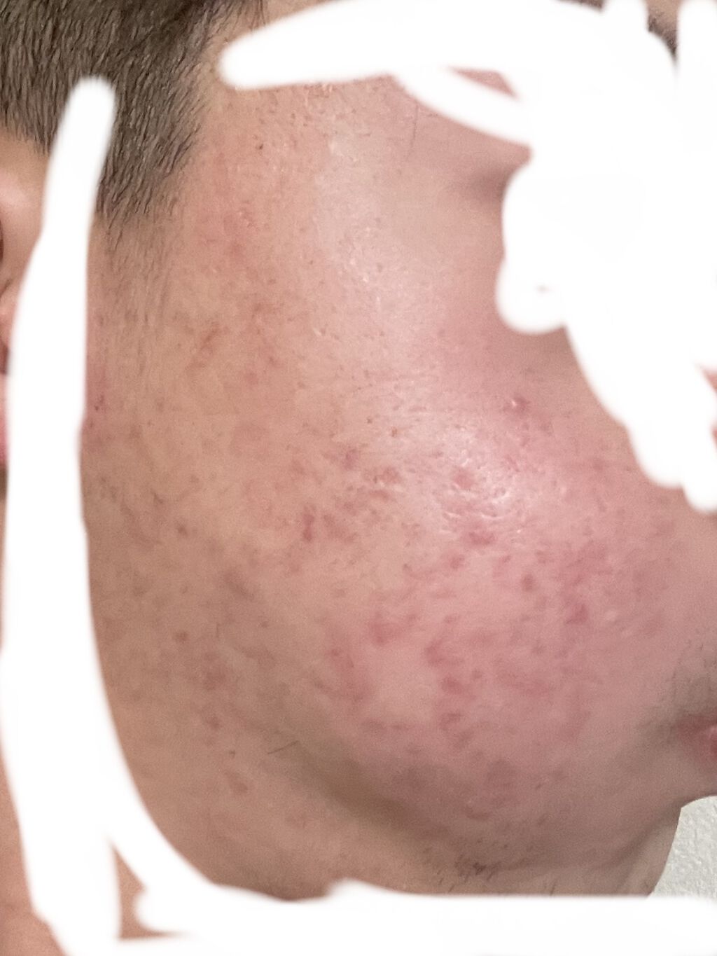 イソトレチノイン/イソトレチノイン/美容サプリメントを使ったクチコミ（2枚目）