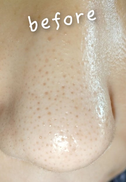 アンチポアブラックヘッドパーフェクトクリアキット/CNP Laboratory/シートマスク・パックを使ったクチコミ(2枚目)