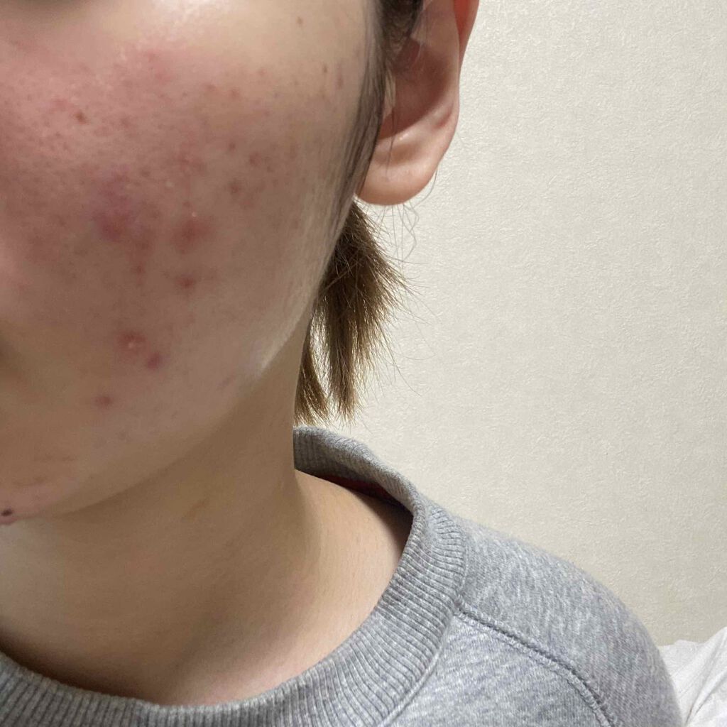 クリンダマイシンゲル(医薬品)/クラシエ薬品/その他を使ったクチコミ（2枚目）