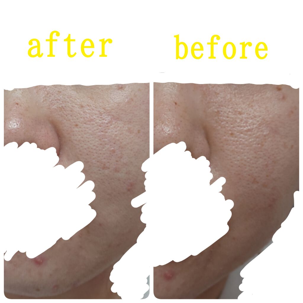 ネイチャーコンク 薬用クリアローション/ネイチャーコンク/拭き取り化粧水を使ったクチコミ（3枚目）