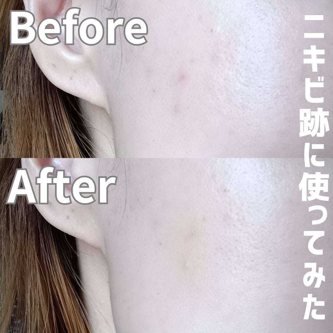 薬用コンシーラー アクネプロテクター/ONLY MINERALS/パウダーコンシーラーを使ったクチコミ(4枚目)