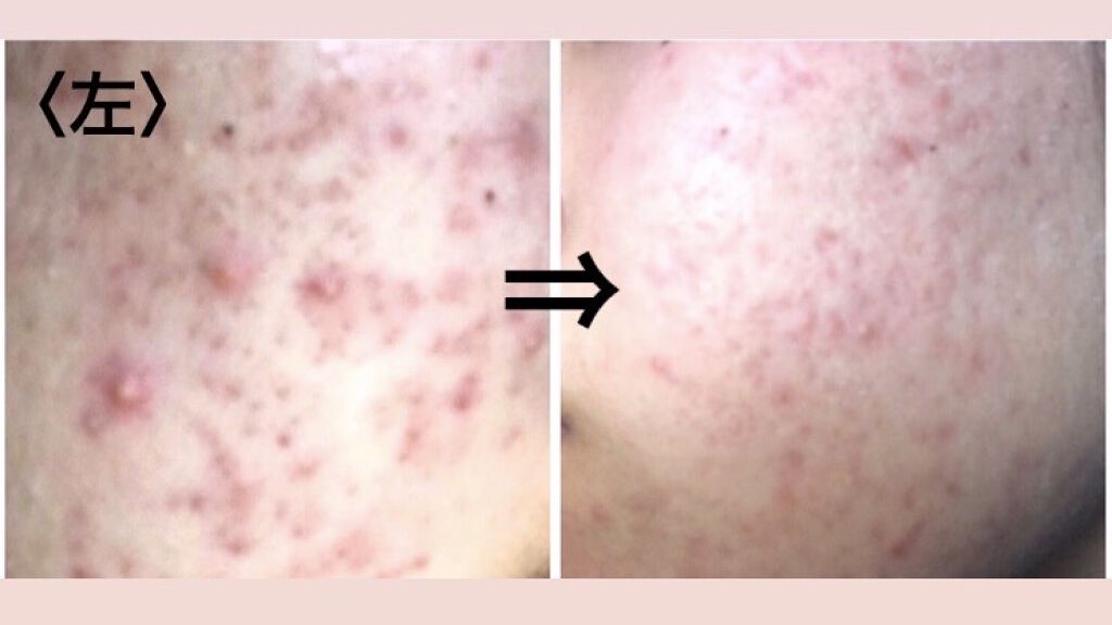 エピデュオゲル/マルホ株式会社/その他を使ったクチコミ（2枚目）