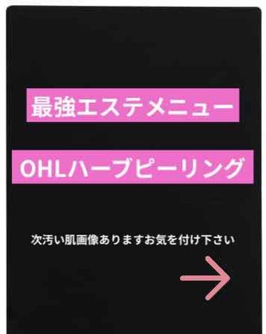 今回は一番大事な【週一でハーブピーリングに通う】です。

2枚目上はハーブピーリング1回目
下はハーブピーリング8回目の画像でございます

ハーブピーリングご存じですか？
私がやったのは
･リベルハーブ