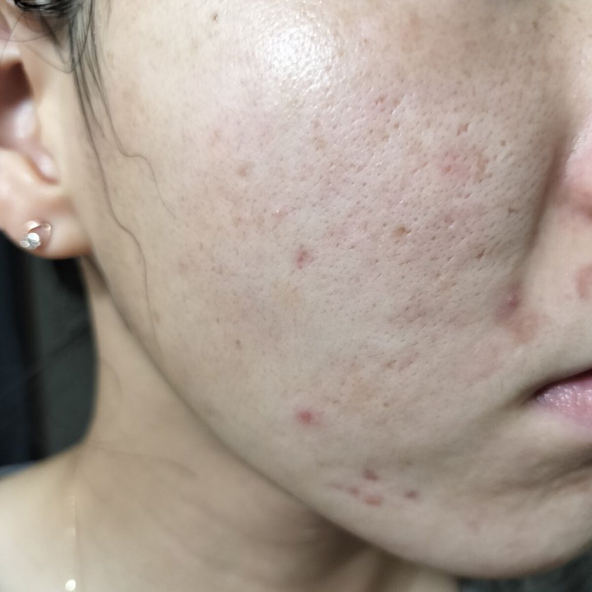 AZアゼライン酸10セラム/コスデバハ/美容液を使ったクチコミ（1枚目）