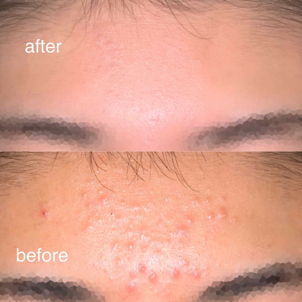 もも on LIPS 「これやったら3週間でニキビがめちゃくちゃ減ってビビります。投稿..」(2枚目)