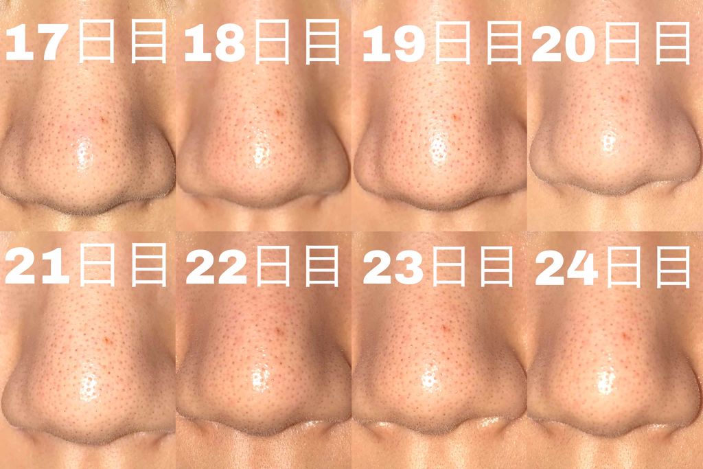 薬用 しみ 集中対策 美容液/メラノCC/美容液を使ったクチコミ（2枚目）