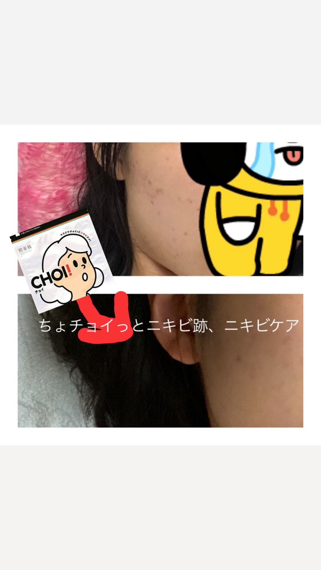 CHOI薬用マスク ニキビケア ［医薬部外品］/肌美精/シートマスク・パックを使ったクチコミ（1枚目）